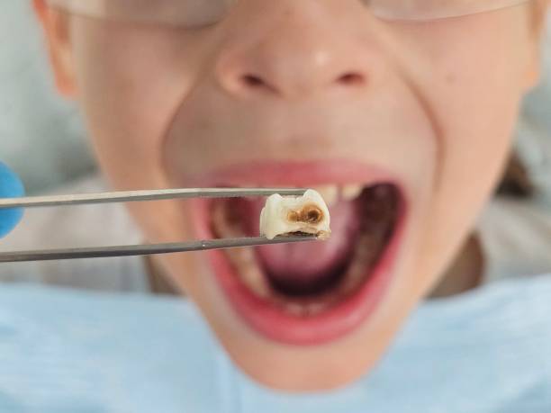 Best Emergency Dental Filling Replacement  in Yadkinville, NC